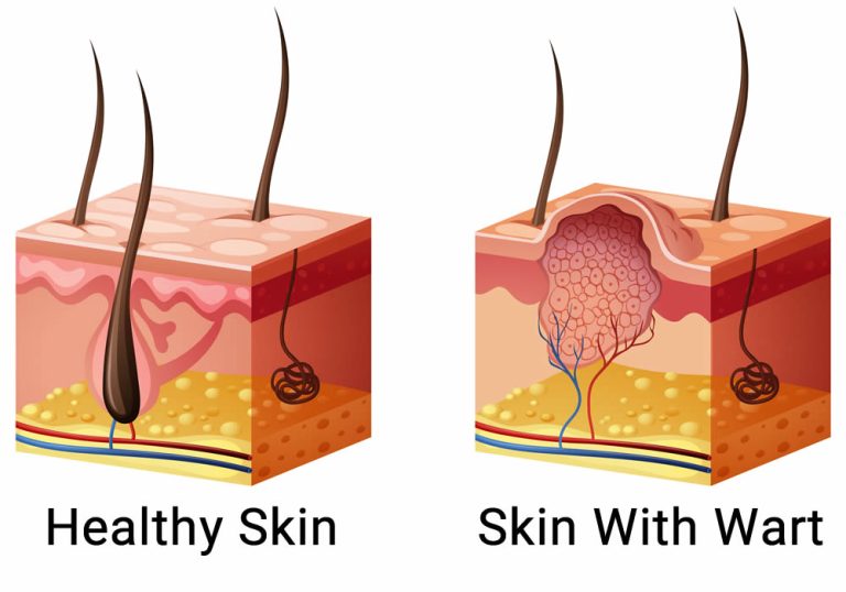 Wart Anatomy of Verruca Vulgaris
