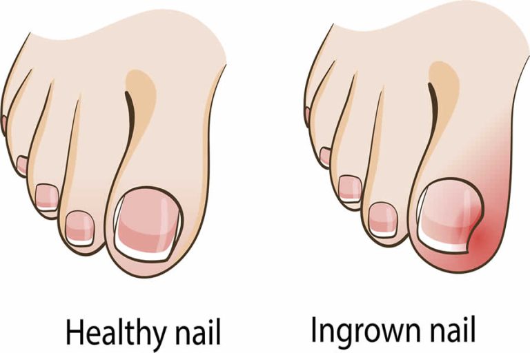 Ingrown Toenail