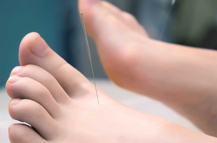 Dry Needling Foot for Podiatry 2