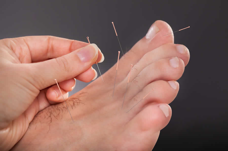 Dry Needling Foot for Podiatry