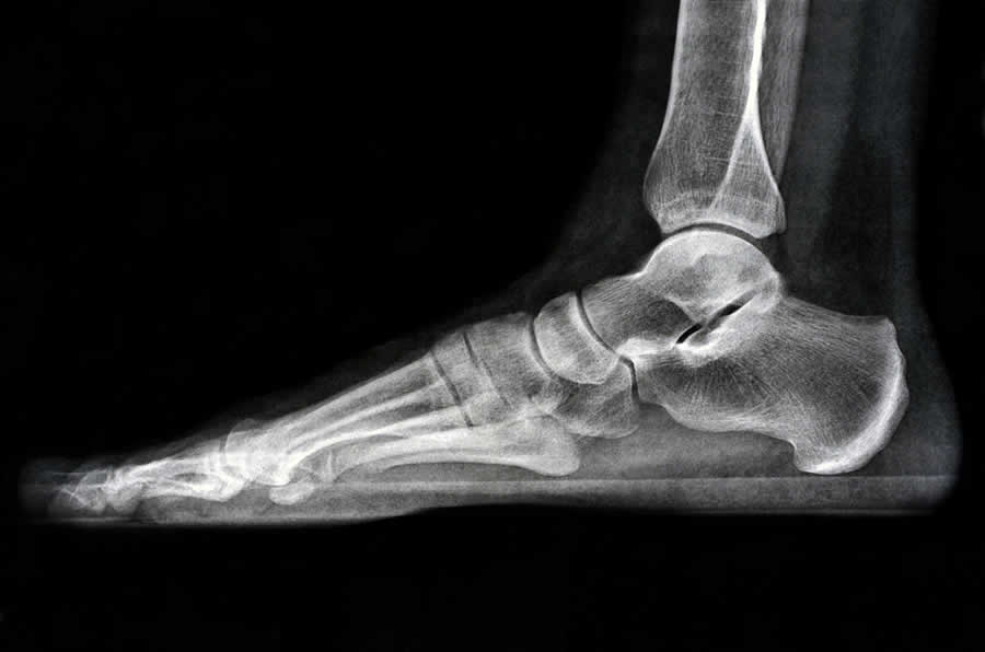 X-Ray of Foot